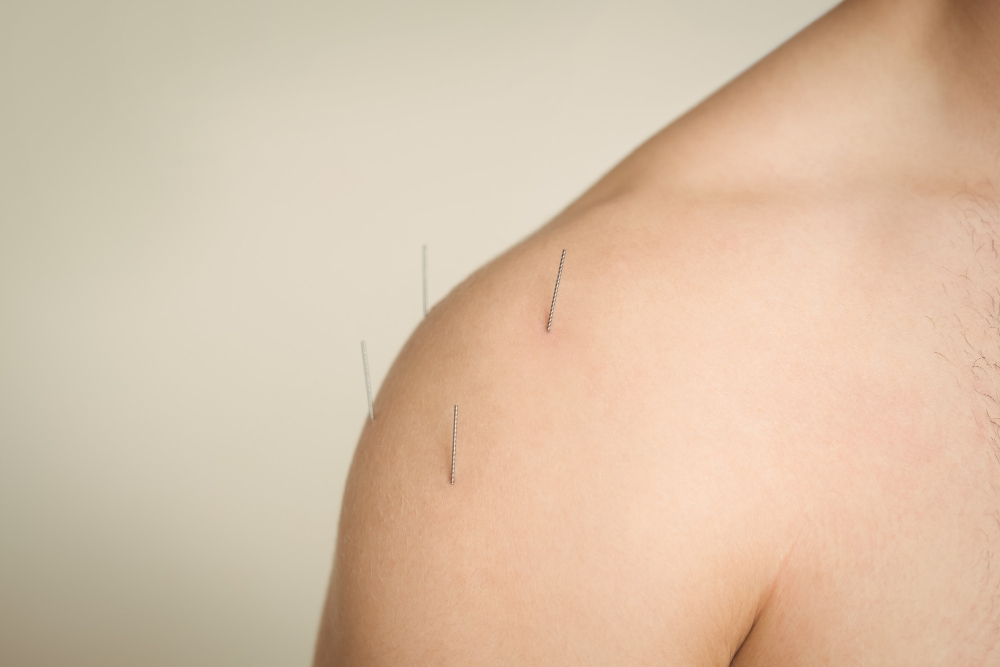 Trigger Point Injections
